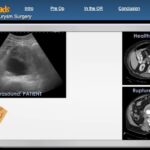 Aortic Aneurysm Surgery 00005